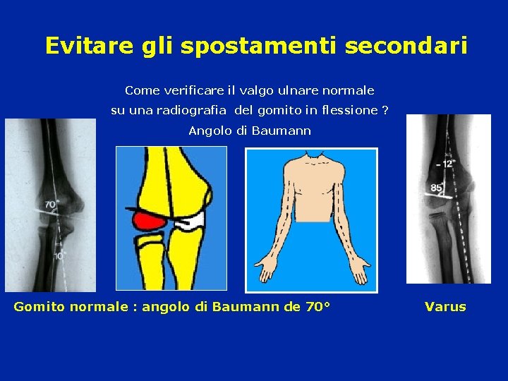 Evitare gli spostamenti secondari Come verificare il valgo ulnare normale su una radiografia del