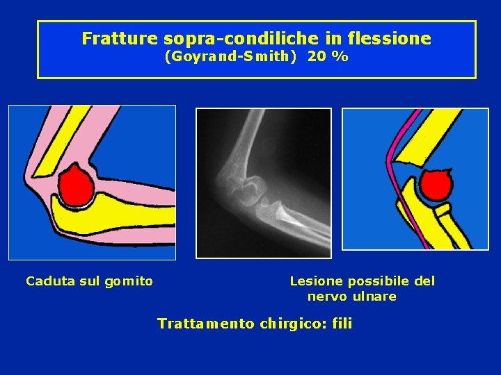 Fratture sopra-condiliche in flessione (Goyrand-Smith) 20 % Caduta sul gomito Lesione possibile del nervo