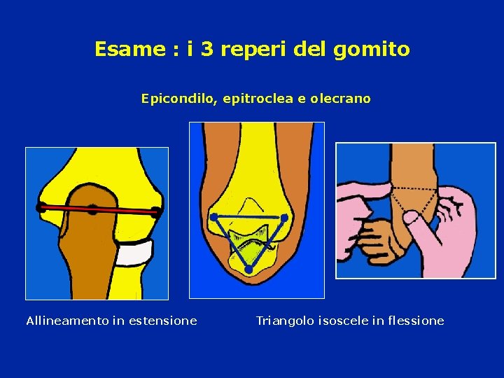 Esame : i 3 reperi del gomito Epicondilo, epitroclea e olecrano Allineamento in estensione