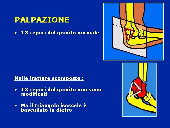 PALPAZIONE • I 3 reperi del gomito normale Nelle fratture scomposte : • I