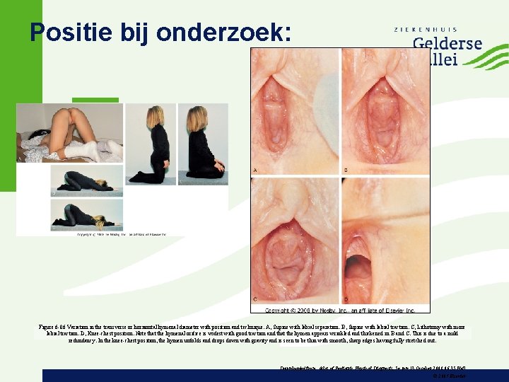 Positie bij onderzoek: Figure 6 -86 Variation in the transverse or horizontal hymenal diameter