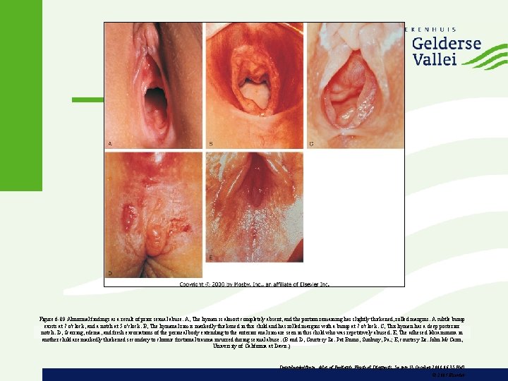 Figure 6 -89 Abnormal findings as a result of prior sexual abuse. A, The