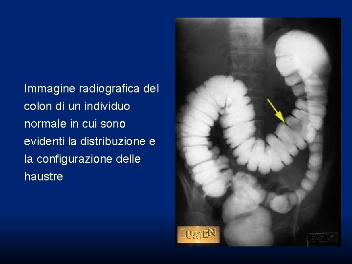 Immagine radiografica del colon di un individuo normale in cui sono evidenti la distribuzione Immagine radiografica del colon di un individuo normale in cui sono evidenti la distribuzione
