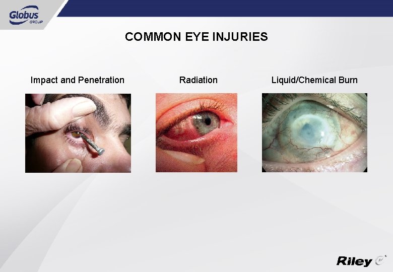 COMMON EYE INJURIES Impact and Penetration Radiation Liquid/Chemical Burn 