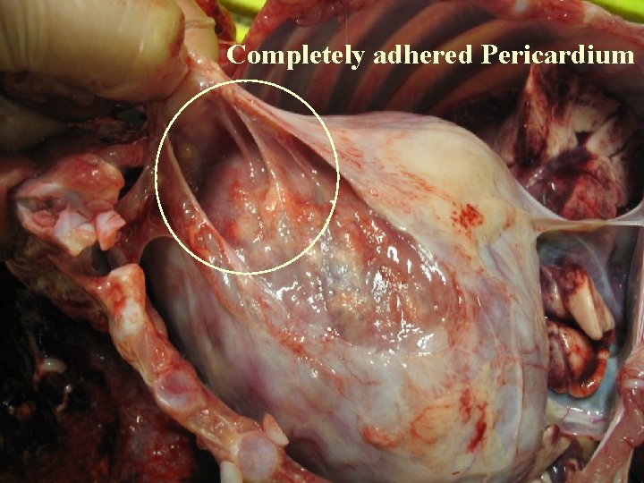 Completely adhered Pericardium 
