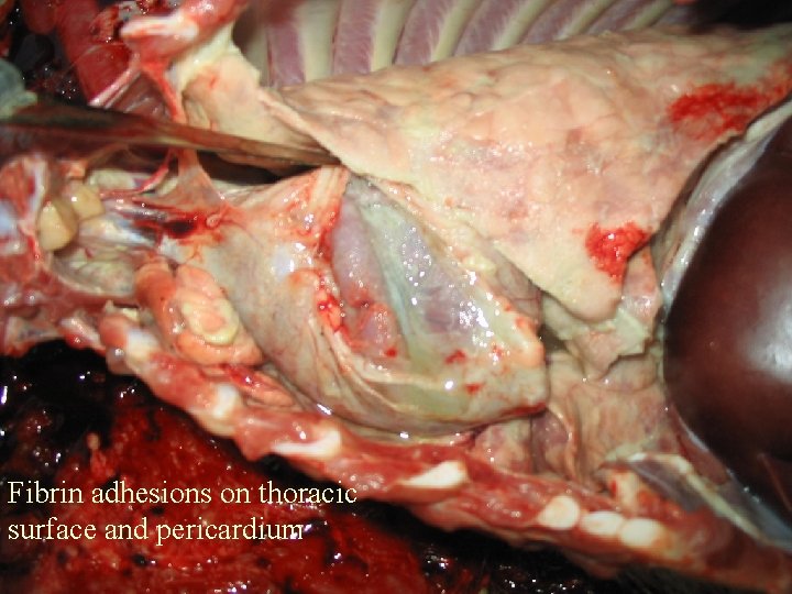 Fibrin adhesions on thoracic surface and pericardium 
