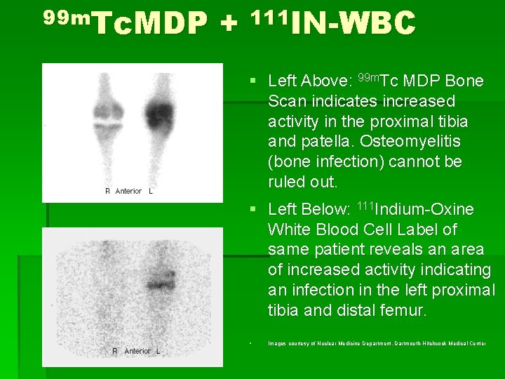 Leukocyte Imaging The Diagnostic Applications of Labeled WBCs