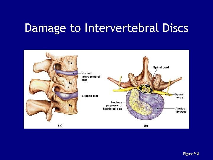 Damage to Intervertebral Discs Figure 9– 8 