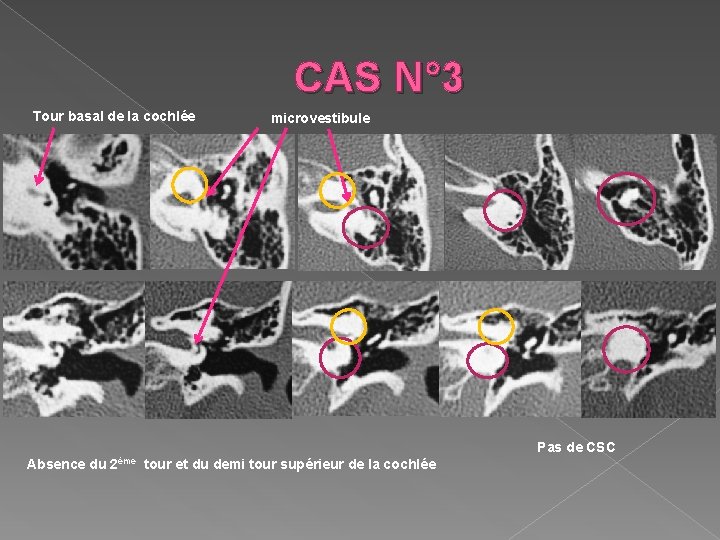 CAS N° 3 Tour basal de la cochlée microvestibule Pas de CSC Absence du