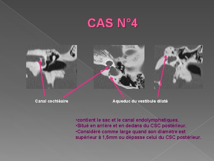 CAS N° 4 Canal cochléaire Aqueduc du vestibule dilaté • contient le sac et
