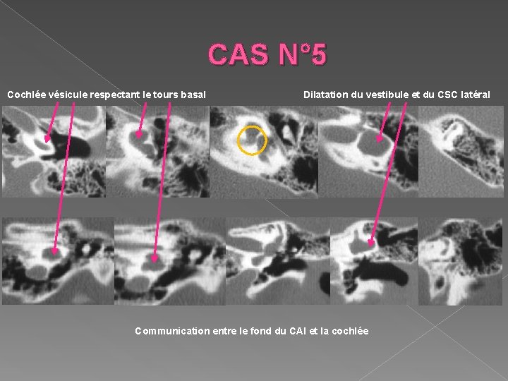 CAS N° 5 Cochlée vésicule respectant le tours basal Dilatation du vestibule et du