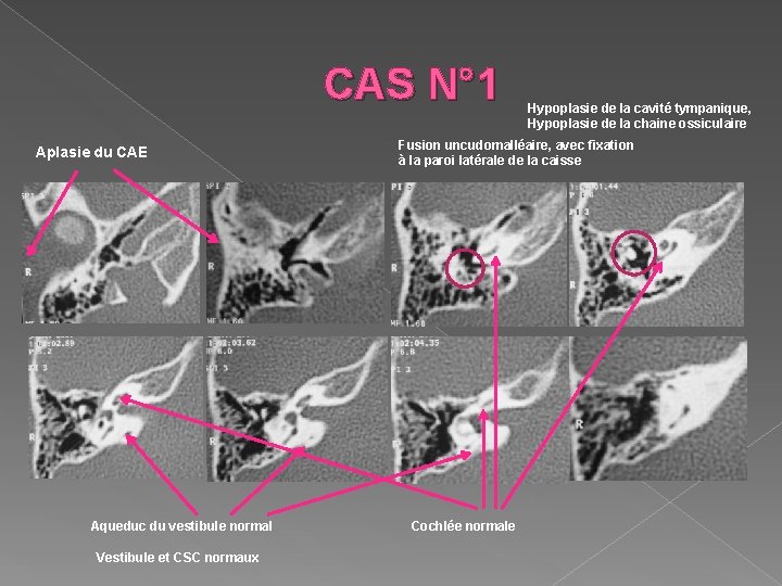 CAS N° 1 Aplasie du CAE Aqueduc du vestibule normal Vestibule et CSC normaux