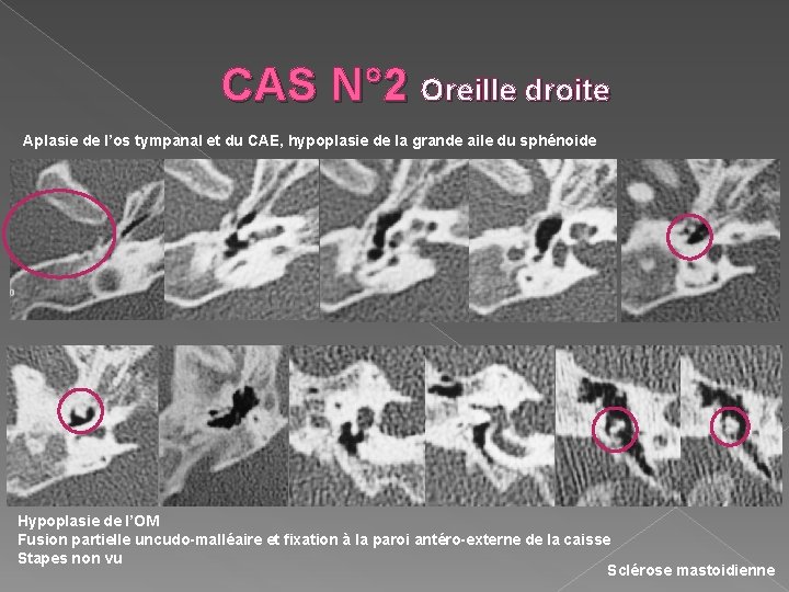 CAS N° 2 Oreille droite Aplasie de l’os tympanal et du CAE, hypoplasie de