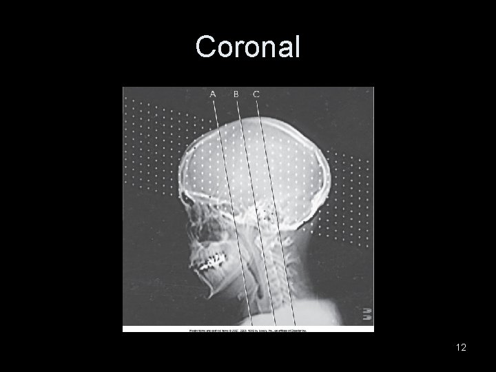 Coronal 12 