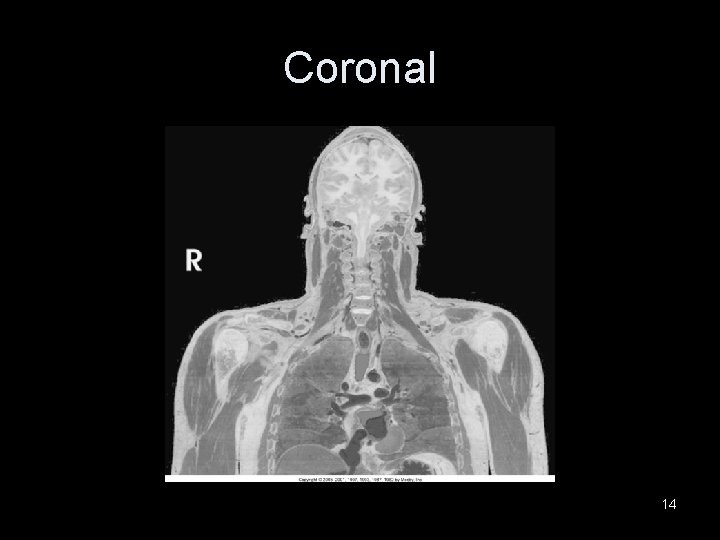 Coronal 14 