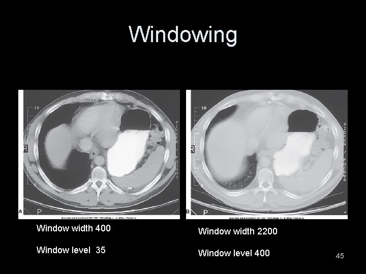 Windowing Window width 400 Window width 2200 Window level 35 Window level 400 45