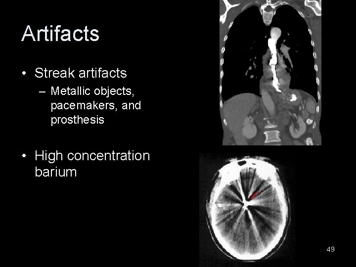 Artifacts • Streak artifacts – Metallic objects, pacemakers, and prosthesis • High concentration barium