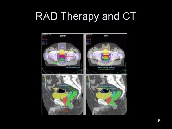 RAD Therapy and CT 64 