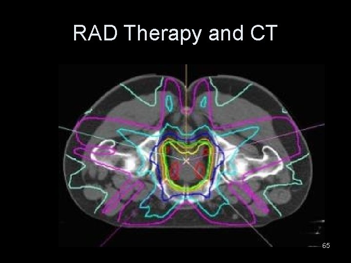 RAD Therapy and CT 65 