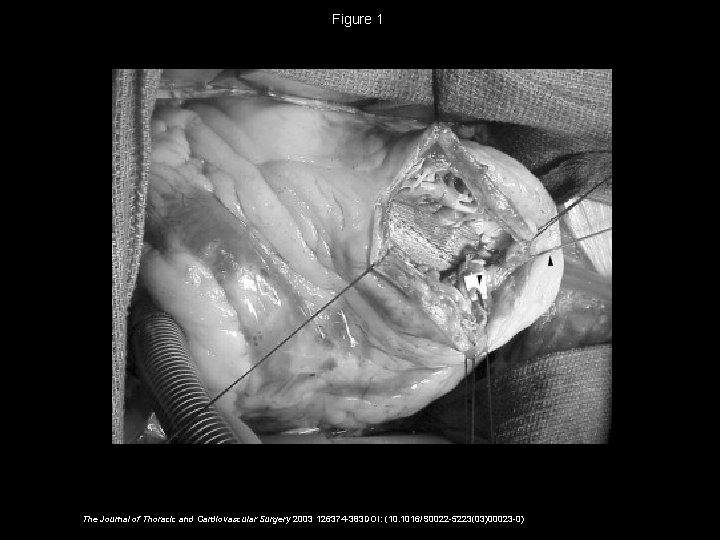 Figure 1 The Journal of Thoracic and Cardiovascular Surgery 2003 126374 -383 DOI: (10.