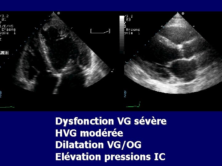 Dysfonction VG sévère HVG modérée Dilatation VG/OG Elévation pressions IC 