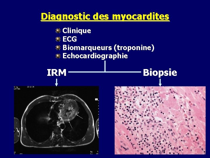 Diagnostic des myocardites Clinique ECG Biomarqueurs (troponine) Echocardiographie IRM Biopsie 