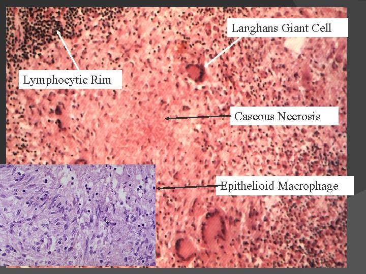 Granuloma Langhans Giant Cell Lymphocytic Rim Caseous Necrosis Epithelioid Macrophage 