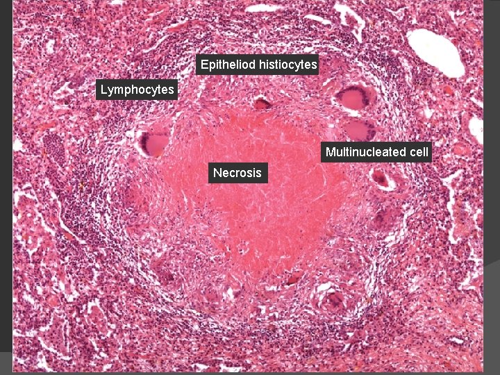Epitheliod histiocytes Lymphocytes Multinucleated cell Necrosis 