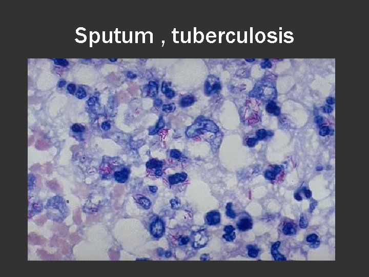 Sputum , tuberculosis 