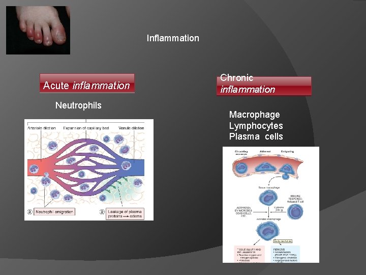 Inflammation Acute inflammation Neutrophils Chronic inflammation Macrophage Lymphocytes Plasma cells 