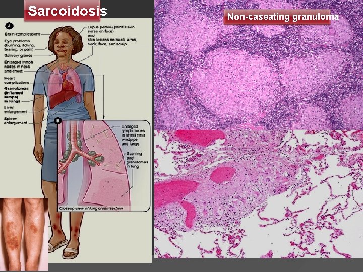 Sarcoidosis Non-caseating granuloma 