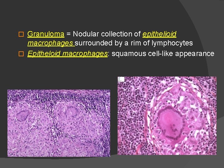 Granuloma = Nodular collection of epithelioid macrophages surrounded by a rim of lymphocytes �