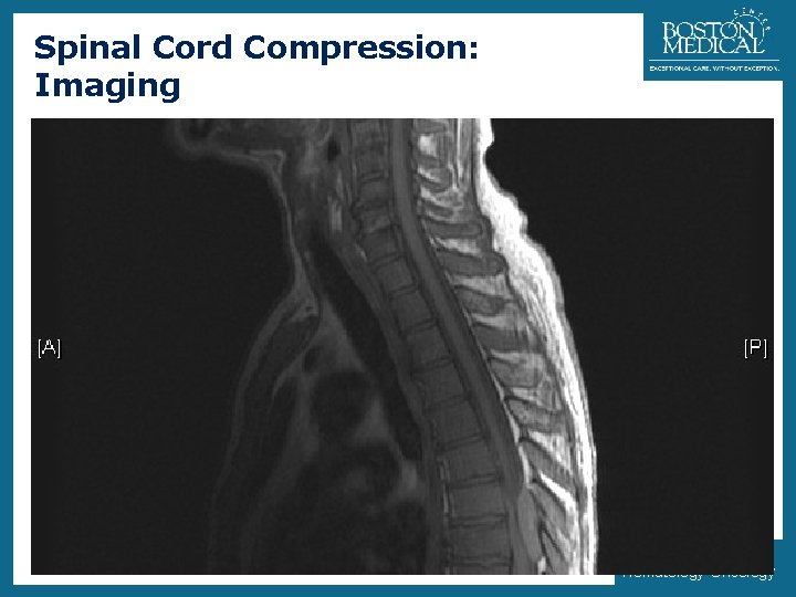 Spinal Cord Compression: Imaging 14 • MRI vs Myelography • 33% will have multiple