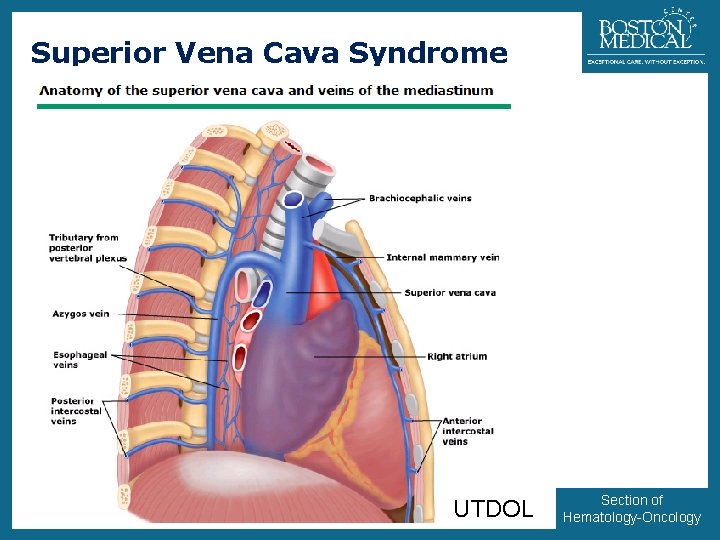 Superior Vena Cava Syndrome UTDOL 33 Section of Hematology-Oncology 