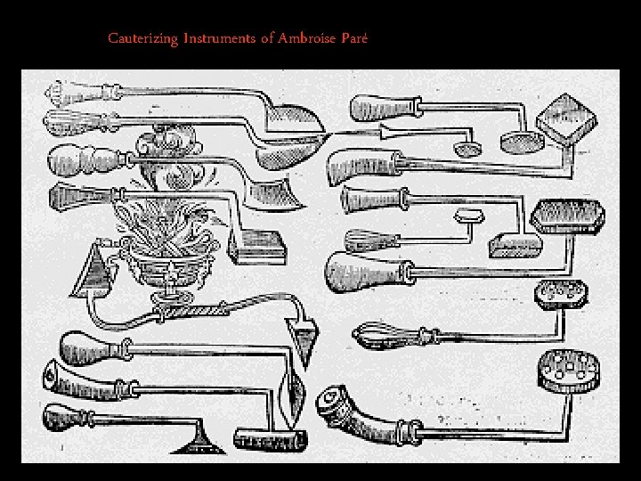 Cauterizing Instruments of Ambroise Paré 