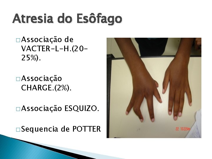 Atresia do Esôfago � Associação de VACTER-L-H. (2025%). � Associação CHARGE. (2%). � Associação