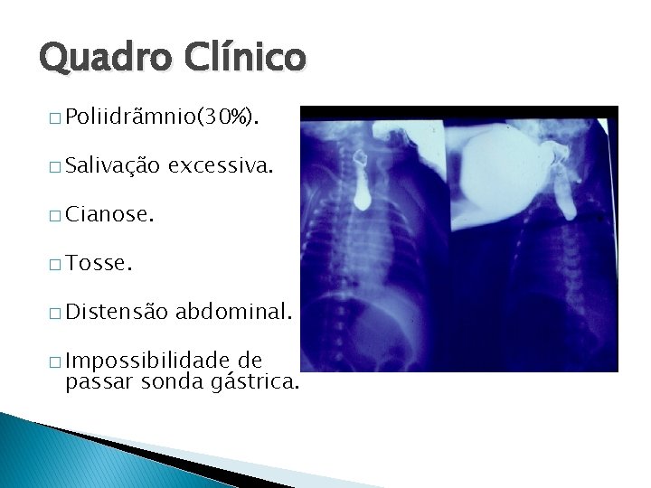 Quadro Clínico � Poliidrãmnio(30%). � Salivação excessiva. � Cianose. � Tosse. � Distensão abdominal.