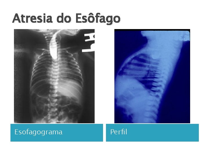 Atresia do Esôfago Esofagograma Perfil 