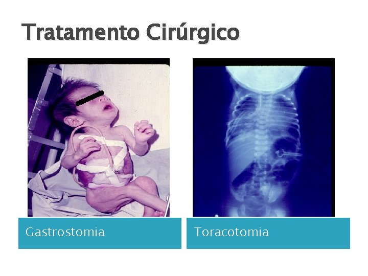 Tratamento Cirúrgico Gastrostomia Toracotomia 