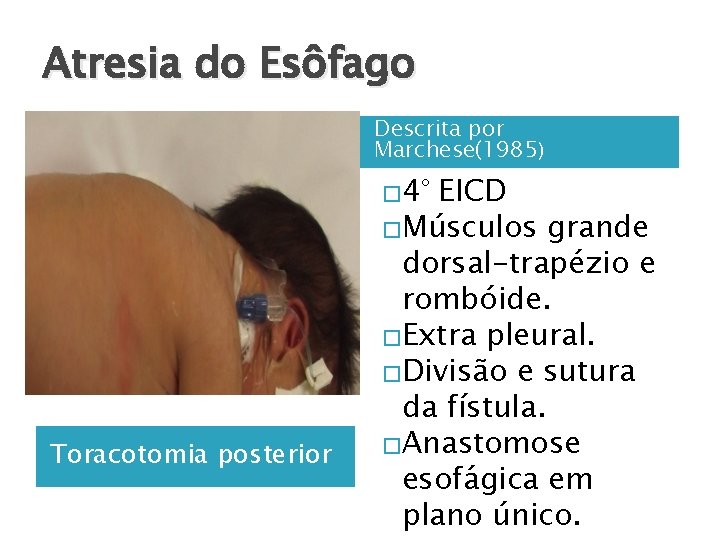 Atresia do Esôfago Descrita por Marchese(1985) � 4° Toracotomia posterior EICD �Músculos grande dorsal-trapézio