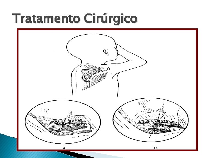 Tratamento Cirúrgico 