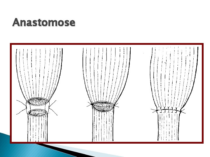 Anastomose 