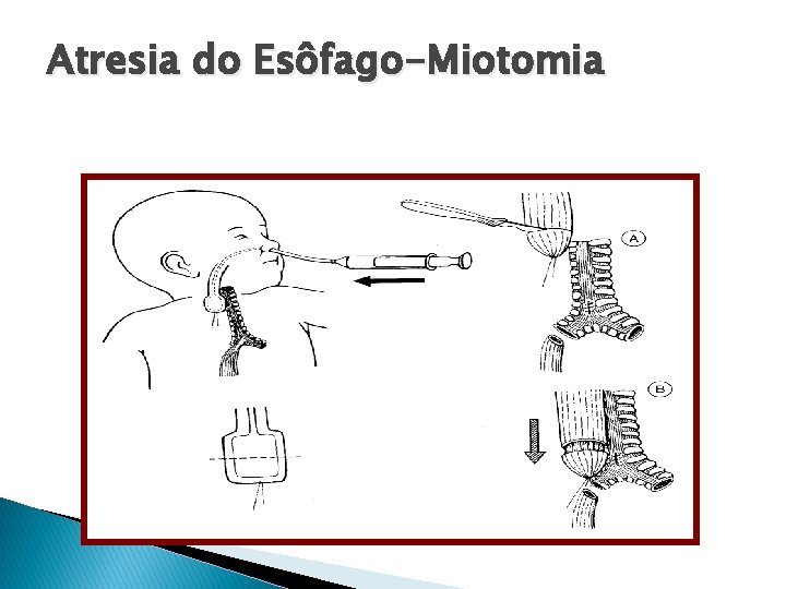 Atresia do Esôfago-Miotomia 
