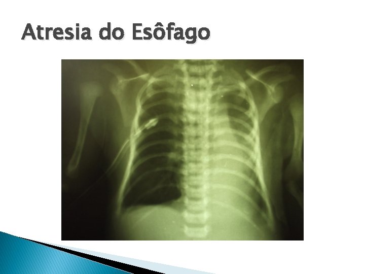 Atresia do Esôfago 