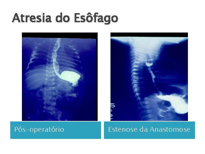 Atresia do Esôfago Pós-operatório Estenose da Anastomose 