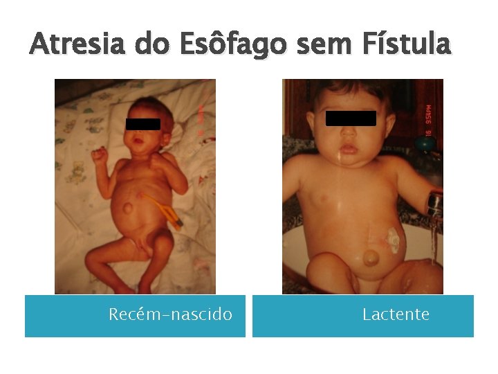 Atresia do Esôfago sem Fístula Recém-nascido Lactente 