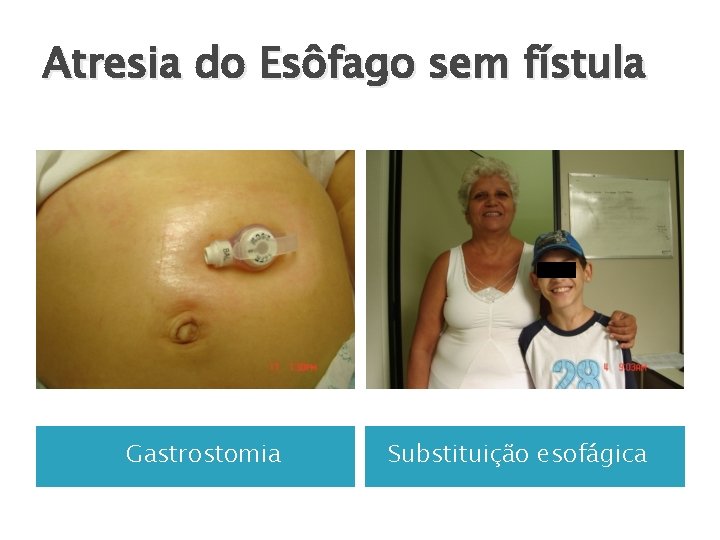 Atresia do Esôfago sem fístula Gastrostomia Substituição esofágica 