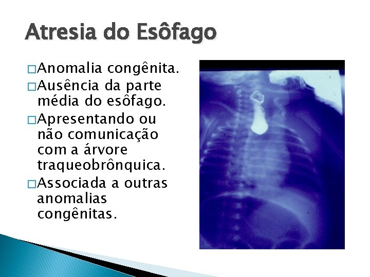 Atresia do Esôfago � Anomalia congênita. � Ausência da parte média do esôfago. �