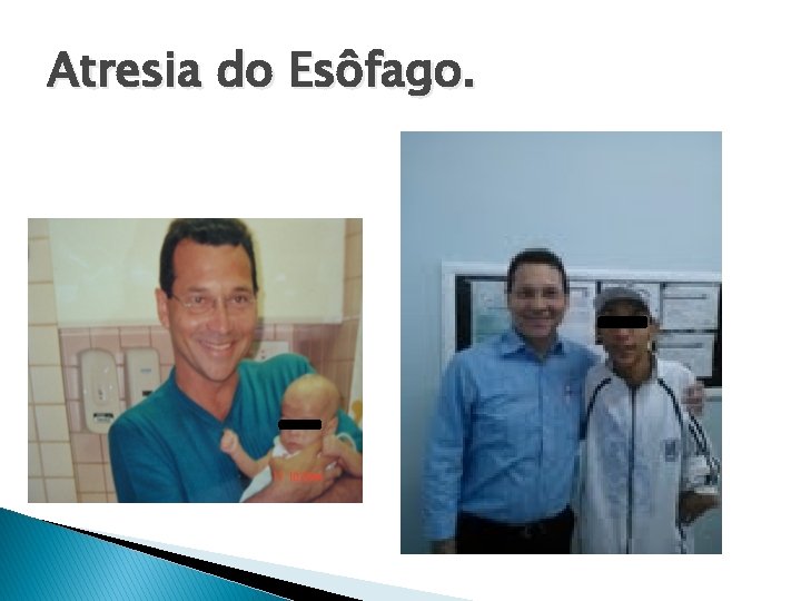 Atresia do Esôfago. 