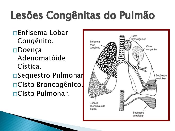 Lesões Congênitas do Pulmão � Enfisema Lobar Congênito. � Doença Adenomatóide Cística. � Sequestro